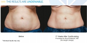 coolsculpt-results-may-vary2