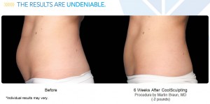 coolsculpt-results-may-vary3